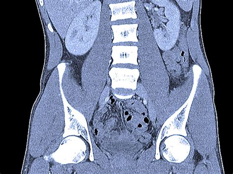 Abdominal CT scans: Definition, uses, picture, and more