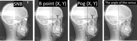 Long-term skeletal stability in the treatment of mandibular prognathism ...