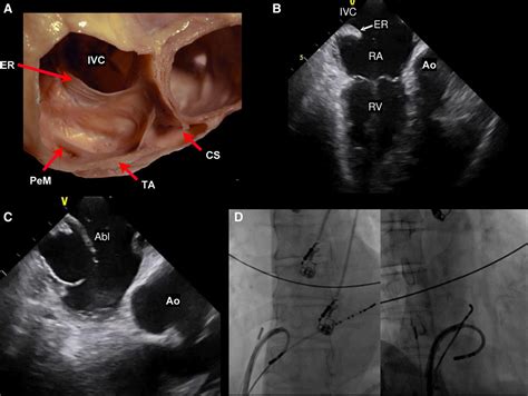 Use of Intracardiac Echocardiography in Interventional Cardiology ...