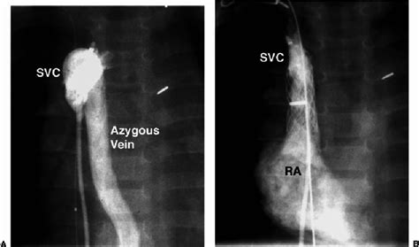 Superior vena cava (SVC) stenting. (A) This child gradually developed... | Download Scientific ...