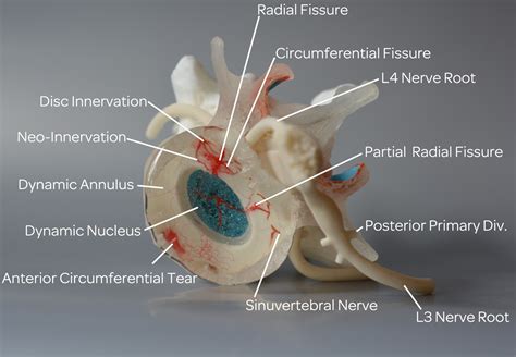 Plain Talk about a Lumbar Herniated Disc - Dynamic Disc Designs