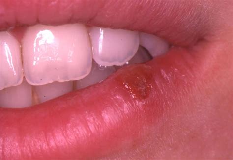 Herpes Simplex Virus (Hsv) Infection Of The Mouth – European ...