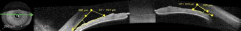 Laser Iridotomy in the Angle-Closure Suspect - Glaucoma Today