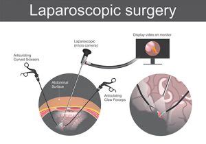 Laparoscopic Surgery - Dr Hayden Homer