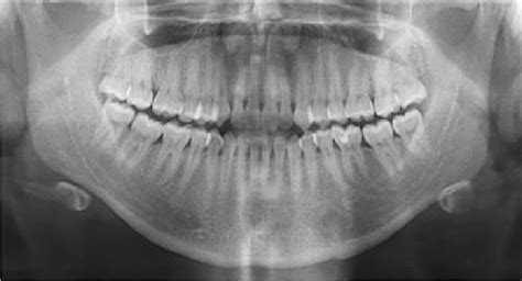 Initial orthopantomography. | Download Scientific Diagram