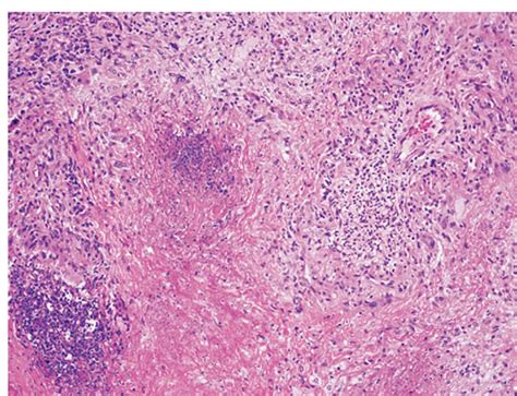 Lung histology in Wegener’s granulomatosis. This area of geographic ...