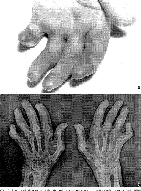 Figure 1 from Anticentromere antibody positive CREST syndrome associated with polyarthritis ...