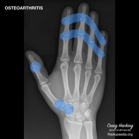 Osteoarthritis | Radiology Reference Article | Radiopaedia.org