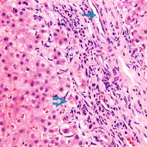 Drug-Induced Cholestatic Liver Injury | Basicmedical Key