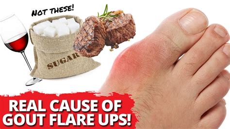 FINALLY Experience FOOD FREEDOM From Gout Attacks.. The REAL Cause Revealed! - YouTube