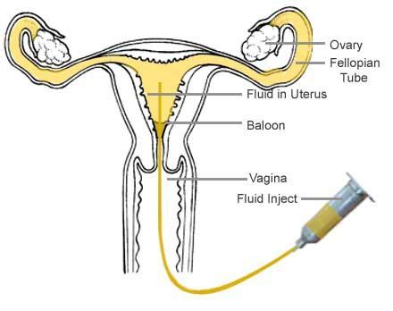 HSG-Hysterosalpingogram (Tube Test) http://www.giftivf.com/femaletubetest.html | Fallopian tubes ...