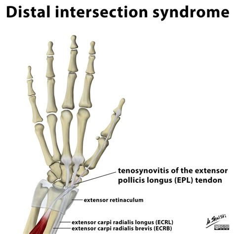 The distal intersection syndrome relates to tenosynovitis of the extensor pollicis longus (EPL ...