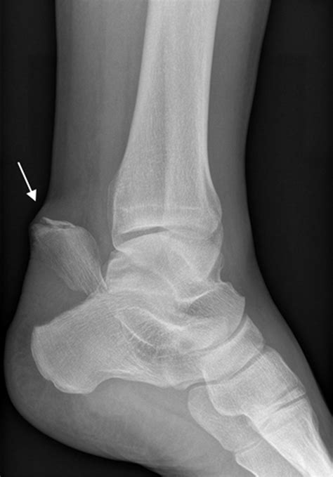 Radiographic Review of Avulsion Fractures RadioGraphics Fundamentals ...