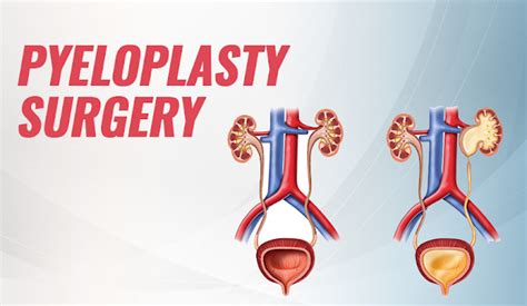 Pyeloplasty Surgery in Bangalore. Why is a pyeloplasty operation… | by ...