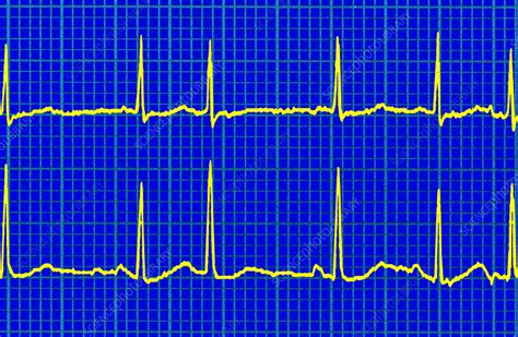 Erratic Heartbeat