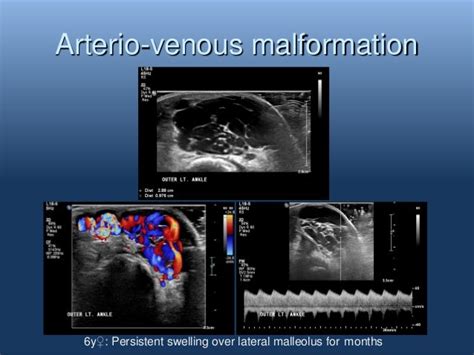 Ultrasound of Vascular anomalies by Oscar M. Navarro