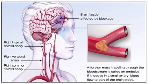 Ischemic stroke illustration (American Stroke Association 2015 ...