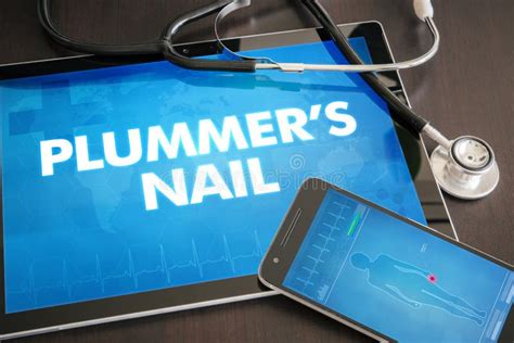 Plummer S Nail (cutaneous Disease) Diagnosis Medical Concept Stock Photo - Image of plummers ...