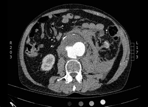 Ruptured Abdominal Aortic Aneurysm - JETem