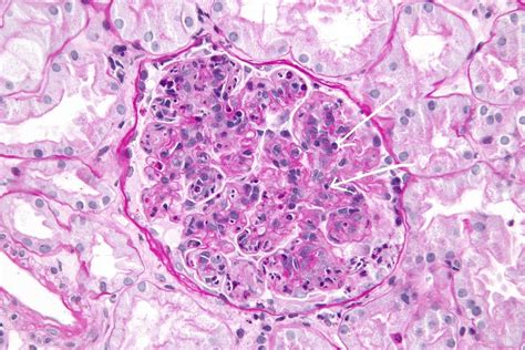 Acute Post Streptococcal Glomerulonephritis | Medical Junction