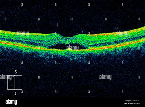 Macular degeneration. Optical coherence tomography (OCT) scan of a ...