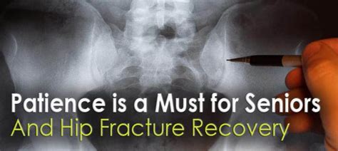 Hip fracture recovery for seniors is a process that is often arduous as well as dangerous. # ...