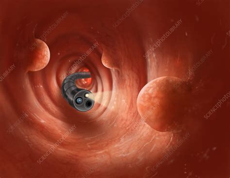 Colonoscopy with Polyps - Stock Image - C022/1035 - Science Photo Library