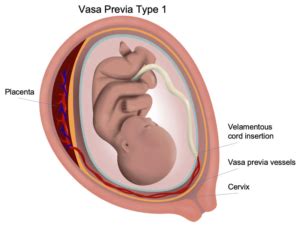 Vasa Previa - Los Angeles Fetal Surgery