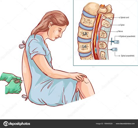 Epidural Nerve Block Injection Stock Vector Image by ©corbacserdar ...