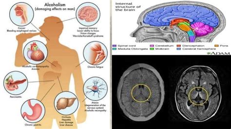 Wernicke korsakoff syndrome ppt