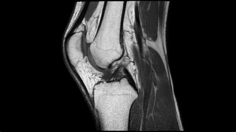 MRI of a normal knee - YouTube