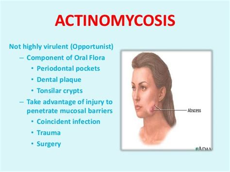 PEOPLE AT RISK WITH ACTINOMYCOSIS • Having a dental disease or recent ...