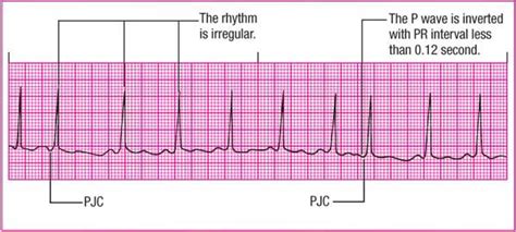 A Premature Junctional Rhythm Interrupts Which of the Following - Ali ...