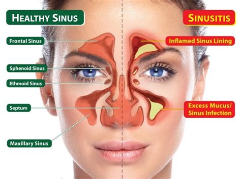 Chronic Sinusitis | Sinus Infection Treatment | Dr. Monica Tadros