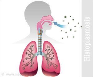 Histoplasmosis | Spelunker’s Lung | Caver’s Disease: Symptoms, Causes, Treatment, Diagnosis