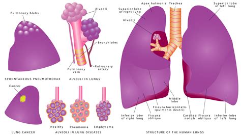 Spontaneous Pneumothorax: Things to Know - The Center for Growth (en-US)