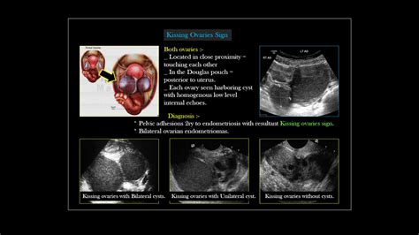 80 Best of Pouch Of Douglas Cyst Ultrasound - insectza