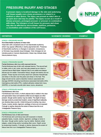 Pressure Ulcer Staging Guide