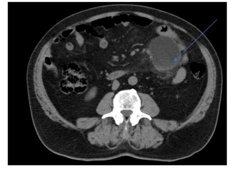 Cureus | Lymphatic Mesenteric Cyst, a Rare Cause of Surgical Abdominal ...