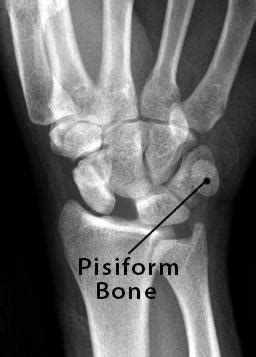 Pisiform Bone Definition, Location, Anatomy, Functions, & Diagram | The ...