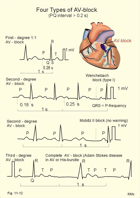 of Adam - Stokes syndrome