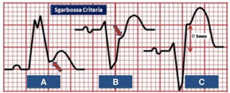 MODIFIED SGARBOSSA CRITERIA – ECG Weekly