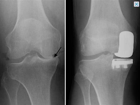 What is a partial knee replacement? - OSMS - Orthopedic and Rheumatology Services in Wisconsin