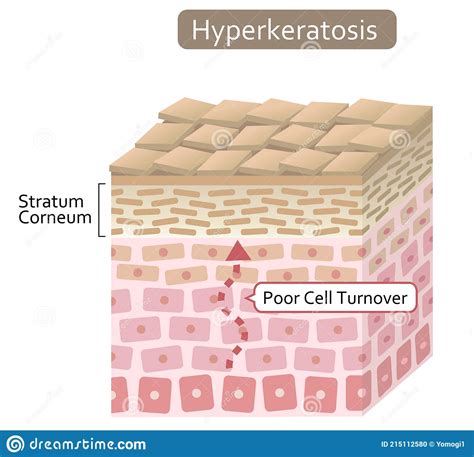 Diagram Of Thickening Of The Stratum Corneum And Woman Face. Before ...