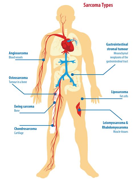 What is Sarcoma?