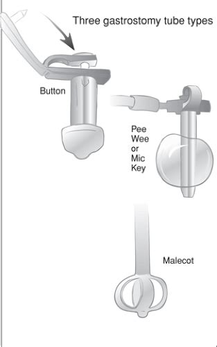 Gastrostomy Tube Replacement | Obgyn Key