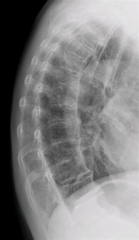 Diffuse idiopathic skeletal hyperostosis - Wikipedia