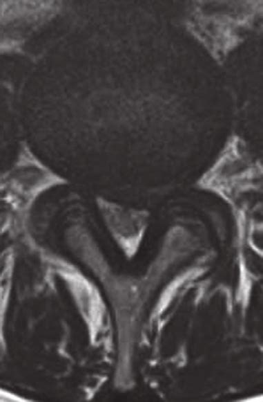 llustrative Case48yearold woman presented with left L5 radiculopathy... | Download Scientific ...