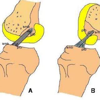 0 – Axial image is used for prescribing the sagittal images parallel to ...