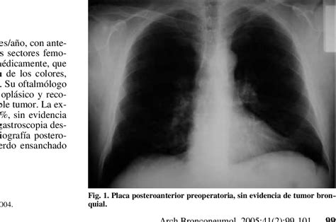 Figure 1 from Carcinoma broncogénico microcítico y retinopatía asociada a cáncer | Semantic Scholar